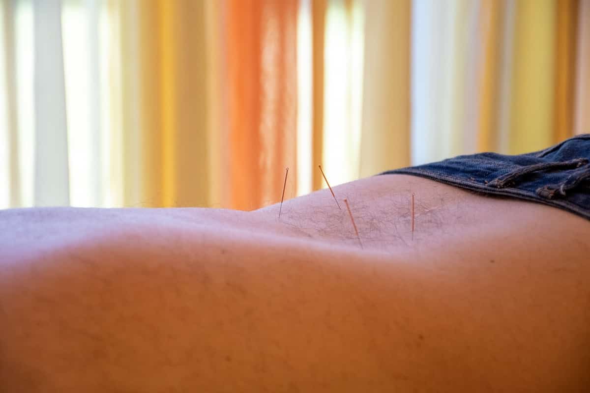 Feine Akupunkturnadeln im unteren Rückenbereich