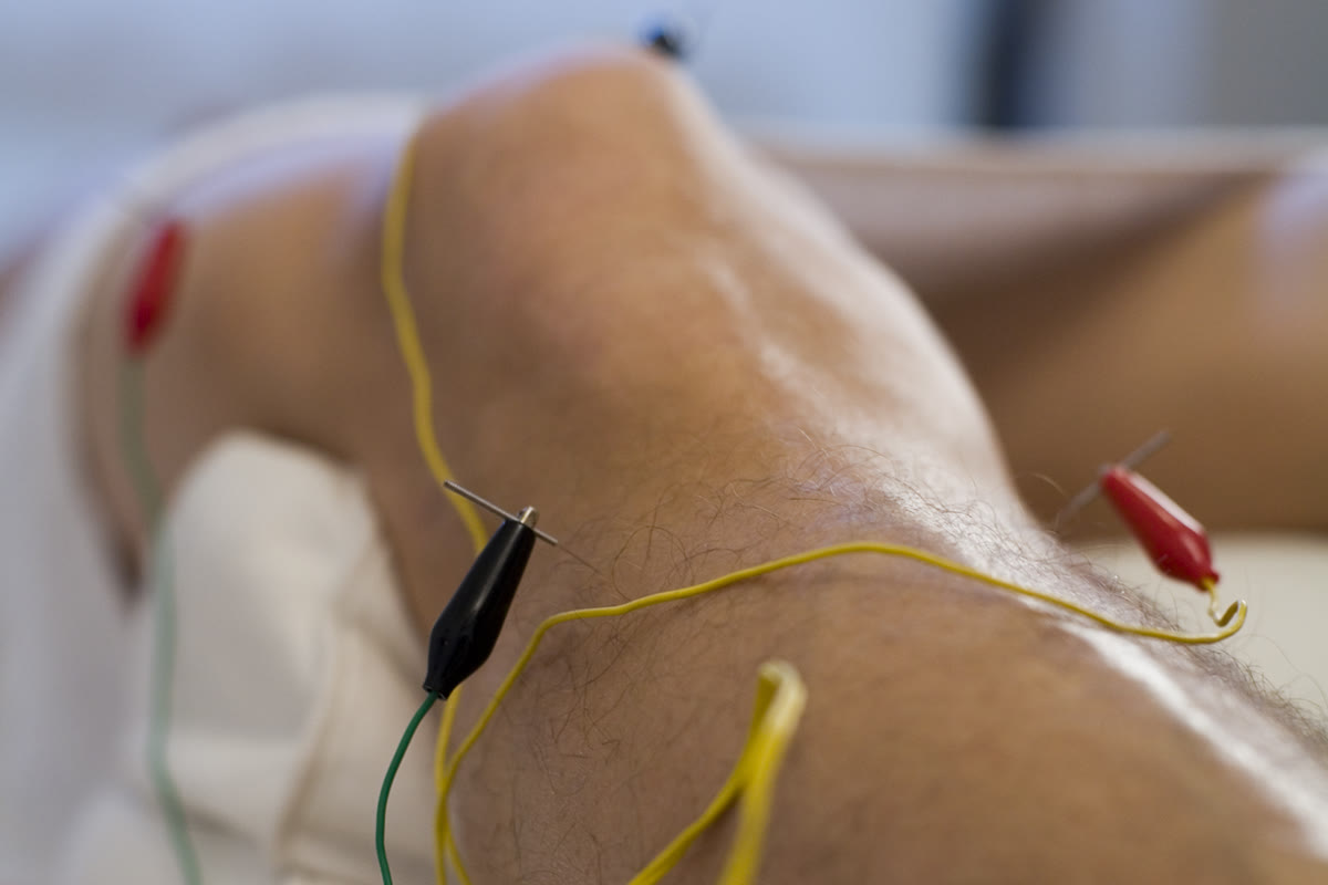 Elektroakupunktur am Knie: Nadeln mit Kabelklemmen, im Hintergrund das Stimulationsgerät